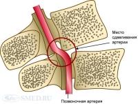 Синдром шейной артерии